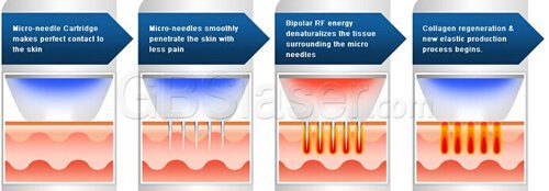 micro needling machine, Fractional micro needling rf