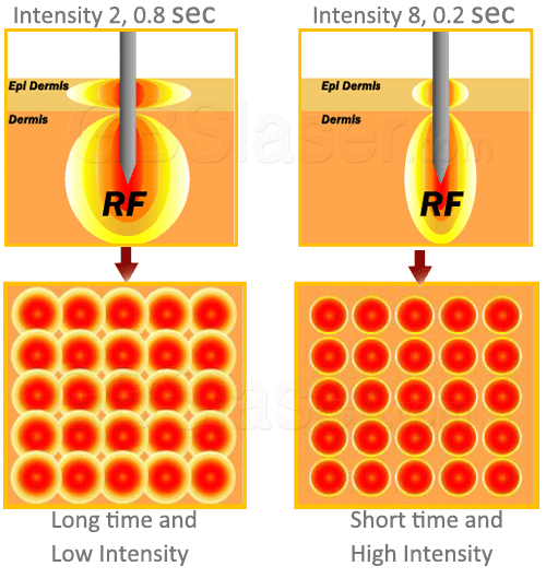 radiofrequency for skin tightening, face tightening machine