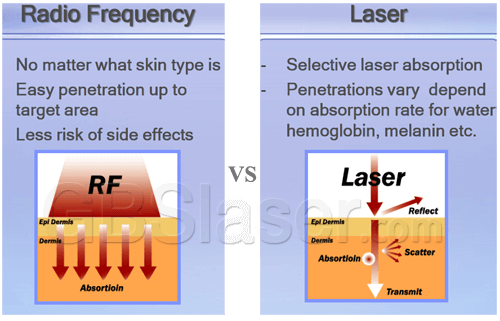 Needle rf fractional, Difference between Fractional micro needle RF and laser