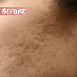 fractional microneedle rf acne scar removal before