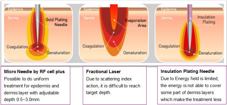 Microneedle rf, microneedling acne scars