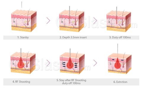 skin rejuvenation machine, endymed 3deep cost