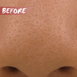 fractional microneedle rf enlarged pore before