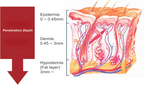 non surgical skin tightening, fractional rf microneedle