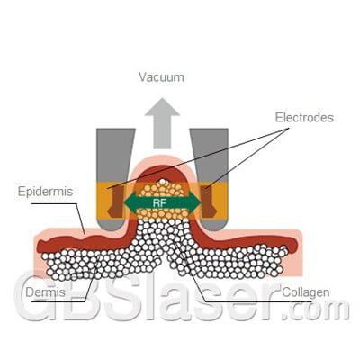 Bipolar RF Plus Vacuum