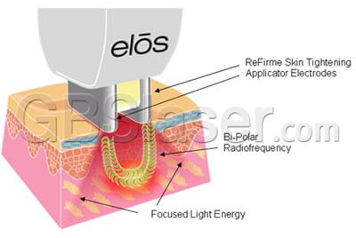 Body Contouring Using a Combination of Pulsed Ultrasound and Unipolar Radio  Frequency: A Prospective Pilot Study