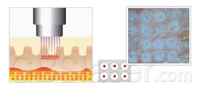 Fractional microneedle RF