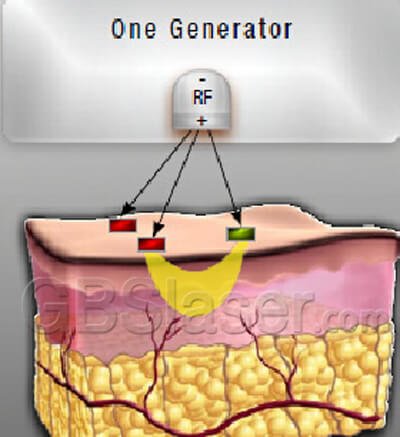 bipolar RF