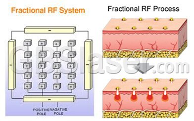 fractional RF