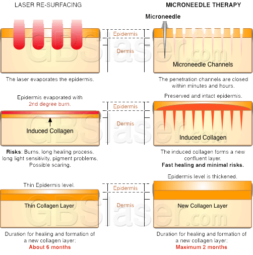 skinpen micronedling, Microneedling VS laser