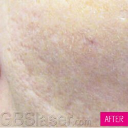Oxygen Jet Peel acne scars