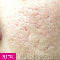 Oxygen Jet Peel acne scar