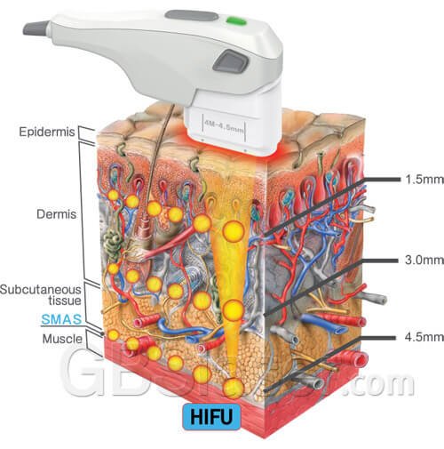 high intensity focused ultrasound, ultherapy machine price