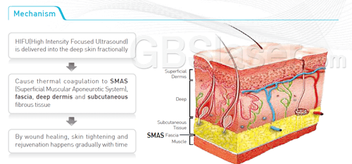 ulthera, is ultherapy work?