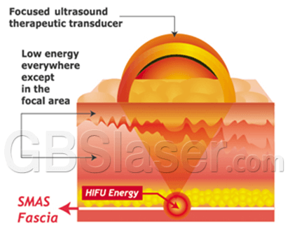 ultrasound facelift, ulthera hifu