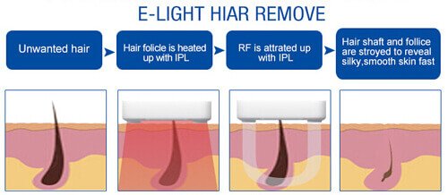Elight Hair Removal
