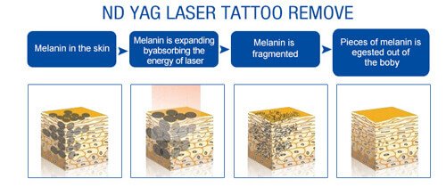 Nd Yag Laser tattoo removal