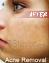 LED blue light acne removal after
