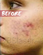 LED blue light acne removal before