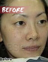 LED pigmentation removal before